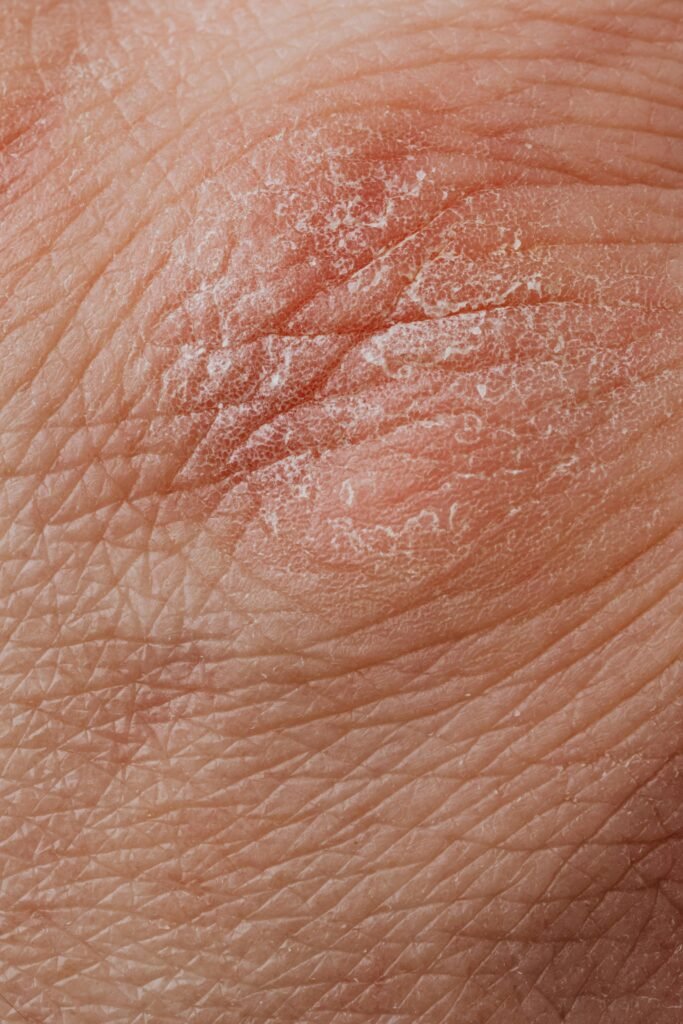 pexels-photo-4046564-4046564 Detailed image highlighting dry, flaky skin texture for dermatological study.