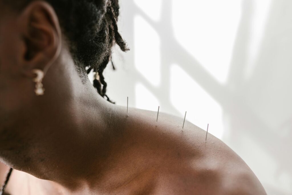 pexels-photo-8312859-8312859 Detailed view of acupuncture needles applied to a shoulder for therapeutic treatment.